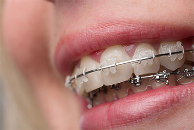 Stereotype Op maat Wetenschap Orthodontie - Tandarts Cooper